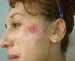 Image result for Neurotic Excoriation