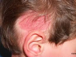 A minority presented scalp telangiectasia. Hair Loss Dermnet Nz
