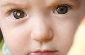 Cancers in children are sometimes hard to recognize because common illnesses or everyday bumps and bruises can mask the early warning signs. Retinoblastoma Awareness Week Common Childhood Eye Cancer Often Goes Undiagnosed New York Eye Cancer Center