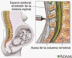 Anestesia Epidural Durante El Parto Salud