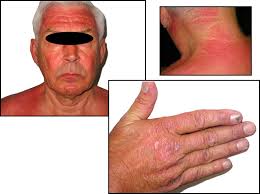 Terbinafine‐induced dermatomyositis: a case report and literature review of  drug‐induced dermatomyositis