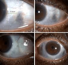 Image result for melanosis sclera