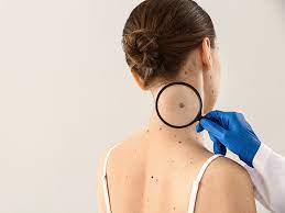There are a number of different treatments doctors recommend. Your Guide To Finding Skin Cancer Before Going For Skin Cancer Clinic Sydney The News God
