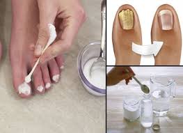 Hongos En Las Uñas De Las Manos Como Eliminarlos Lo Llaman El Arrasador Porque De Una Sola Pasada Elimina Todos Los Hongos De Las Unas De Eliminar Hongos De Las Unas Remedio Para Hongos Infeccion Por Hongos
