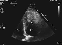 We did not find results for: Left Ventricular Mural Thrombus Despite Treatment With Dabigatran And Clopidogrel Bmj Case Reports