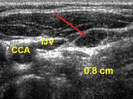 Ultrasonography of neck lymph nodes; Diagnosis Of Papillary Thyroid Cancer
