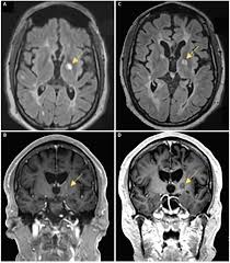 Case Report Hemiparkinsonism In A Patient With Multiple Sclerosis Practical Neurology Stream cogwheel rigidity by stempelstelle from desktop or your mobile device. patient with multiple sclerosis