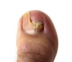 fighting nail fungus with otc solutions