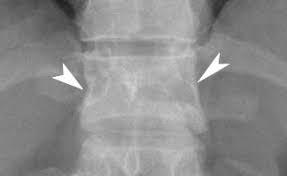 Image result for Chance Fracture