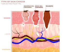 skin cancer is one of the most common cancers in the world. General Dermatology Services At Advanced Dermatology