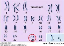 down-syndrom chromosom 21 ile ilgili görsel sonucu