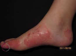 Image result for dermatitis contacta