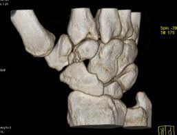 Image result for Trapezoid Bone