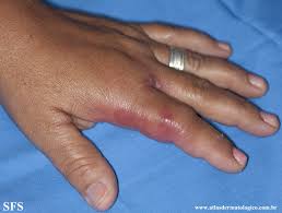 Image result for Erysipeloid