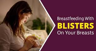 What's the best way to get rid of a blister? 10 Tips For Breastfeeding With A Blister On Your Breast