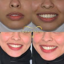 يا ترى احتاجت خلع ولا لا ؟؟ اه التقويم احلى من الفنيير ❤️❤️❤️ الحمدلله ❤️  في حالات كتير جدا بيبقى علاجها الوحيد تقويم مش بس علاجها الامثل 🦷❤️ نقدر  نلاحظ هنا التغير