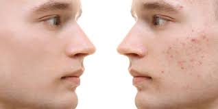 Metode deep cleansing ini ditujukan agar wajah bersih eksim ditandai dengan adanya ruam kemerahan yang menyebabkan beruntusan pada kulit. Bosan Dengan Bruntusan Di Pipi Coba 9 Cara Mudah Berikut Halaman All Kompas Com