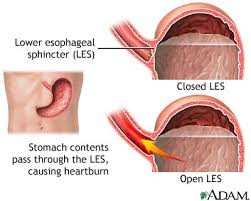 It is caused when gastric acid from your stomach flows back up into your esophagus. Gastroesophageal Reflux Disease Wake Gastroenterology