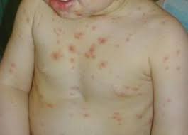 September 6 at 8:23 am ·. La Scarlattina La Malattia Esantematica Che Si Cura Con L Antibiotico A Tutta Mamma