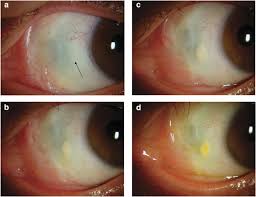 Image result for lesion sclera