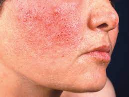 Ivermectin is a medication used to treat many types of parasite infestations. Rosacea Neues Therapieziel Ist Die Vollstandige Erscheinungsfreiheit