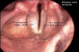 Glottic stenosis is narrowing of the larynx at the level of the glottis (ie, vocal cords). Abnormal Laryngeal Function