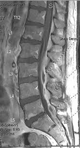 Image result for Spinal Epidural Abscess