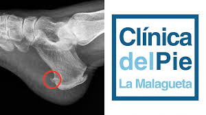 Espolon en el pie imagenes. Que Es El Espolon Calcaneo Principales Causas Y Sus Tratamientos