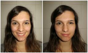 Welke anticonceptiepil helpt tegen acne? Beauty Mijn Strijd Tegen Acne Update 1 Stephanie Van Drunen