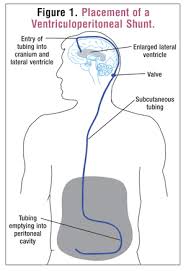 Review Of The Treatment Management Of Hydrocephalus