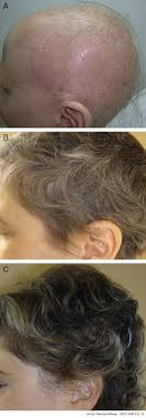 The authors noted that evidence suggests that stem cell constituent extract helps hair regrowth in patients with androgenetic alopecia. New Treatments For Hair Loss Actas Dermo Sifiliograficas