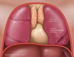 We go beyond medical care to deliver a comprehensive experience that treats the whole child. Congenital Lung Abnormalities Children S Minnesota