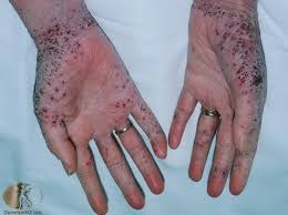The rash causes your skin to change color, itch, swell, become warm, bumpy and painful. Eczema Herpeticum Cause Symptoms Treatment Prevention