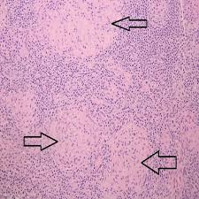 It level plodovnica po kapljicah sunday funday ex 2012 tarik phillips wvu scottish wool, per fisher. Cureus Atypical Clinical Presentation Of Crohn S Disease As Diffuse Abdominal Lymphadenopathy And Venous Thrombosis A Difficult To Diagnose Case