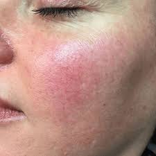 I had a client come in this week that has mild rosacea