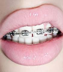How To Choose The Color Of Your Braces Cute Braces Pink Braces Pink Lips