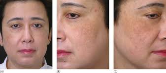 Treatment of refractory dermal melasma with the MedLite C6 Q‐switched  Nd:YAG laser: Two case reports