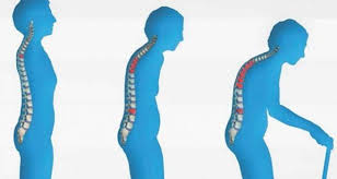 Halk arasında kemik erimesi olarak da bilinen osteoporoz rahatsızlığı, kemikteki dokusu yoğunluğunun veya kitlenin azalması sonucu ortaya çıkan sağlık sorunudur. Menopoz Doneminde Yasanan Kemik Erimesi Tedavi Edilebiliyor