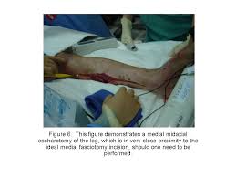 − monitor for return or preservation of circulation (limb) or breathing (chest). 5 Escharotomy Wheeless Textbook Of Orthopaedics