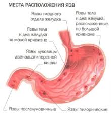 Yazvennaya Bolezn Zheludka Simptomy Diagnostika Lechenie Medcentr Aksis Zelenograd