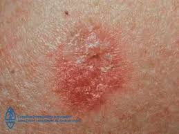 In the case of very small tumors with low risk of recurrence, cryotherapy can also be. Pin On Health And Beauty