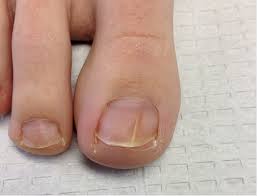 Image result for onychomycosis