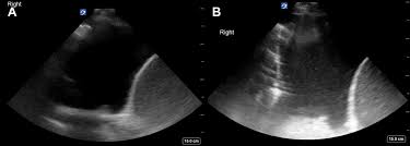 1 article features images from this case 20 public playlist include this case To Tap Or Not To Tap A Pleural Effusion That Is The Question Chest