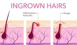 Electrolysis hair removal is the most reliable proven option available today to permanently remove transgender facial and genital hair. Electrolysis Hair Removal The Good The Bad And The Ugly Beauty Harbour