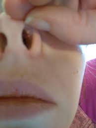 We did not find results for: Two Sizeable Whiteheads Inside My Nose Blurry Because This Is A Very Hard Thing To Photograph Imgur