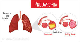 Image result for Pneumonia