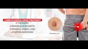 Pilonidal cyst is a pathological disease that is congenital. Update Your Knowledge About Laser Treatment For Pilonidal Sinus