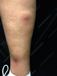 Image result for erythema nodosum