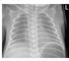 Neonatal chest x ray reading. Figure 4 From Respiratory Distress Of The Term Newborn Infant Semantic Scholar