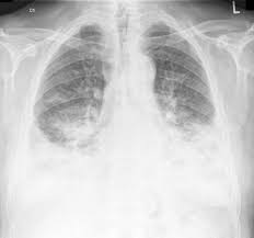 From tb suspects attending a chest clinic in nairobi, kenya, three sputum specimens were examined for zn and culture (lowenstein jensen). Post Primary Pulmonary Tuberculosis Radiology Case Radiopaedia Org